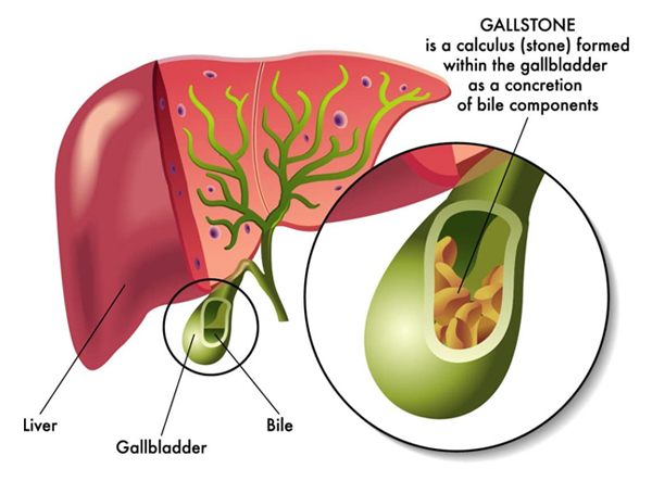 gallbladder surgery in jaipur